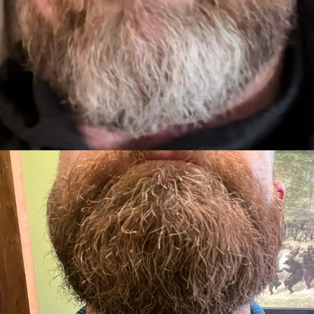 Resultado real en barba